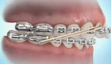 Les Elastiques en Orthodontie - Orthodontiste Sophia Antipolis - Dr Coralie  Thiriez
