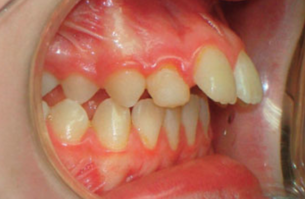 enfant-8-ans-dents-écartées-en-avant-sartrouville-apres-2